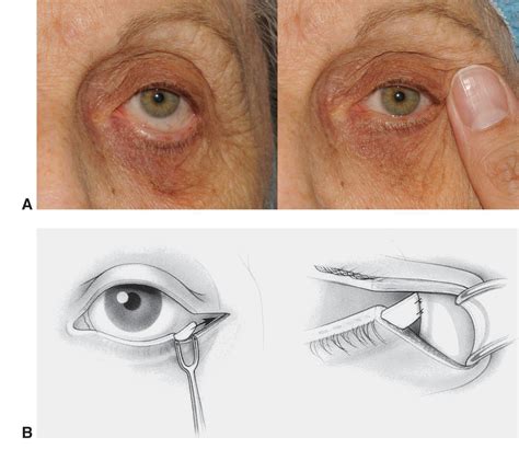 Eyelid Anatomy — Ophthalmology Review