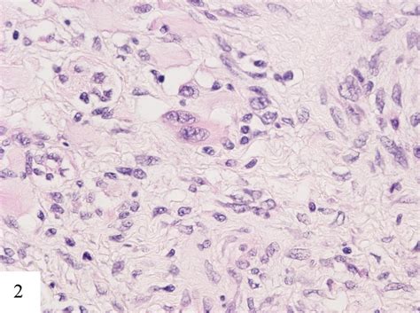 Testicular Seminomatous Mixed Germ Cell Tumor With Choriocarcinoma And Teratoma With Secondary