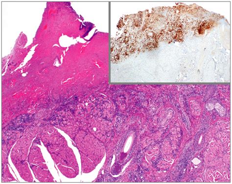 Varicella Zoster Virus Of The Eyelid Dermatology Jama Ophthalmology