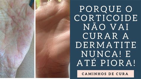 Corticoides NÃO CURAM dermatite Efeito Rebote YouTube