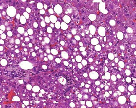 N The Liver Multiple Large Lipid Vacuoles Are Seen Representing A