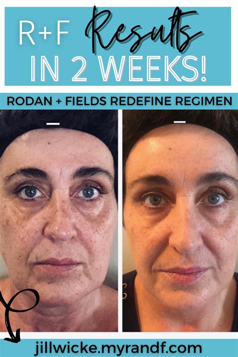 Rodan Fields Redefine Before And After Photos Rodan And Fields