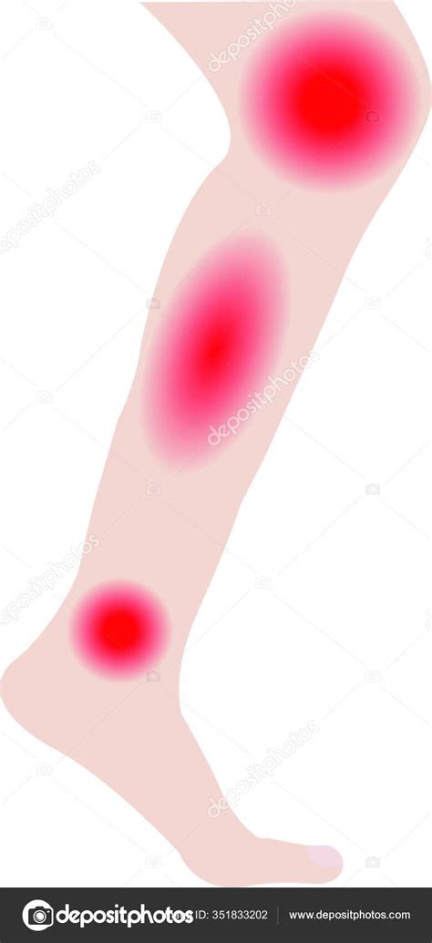 Swelling Leg Ankles Infected Injury Vector Illustration White