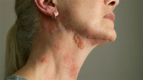 Beginning Stages Of Shingles On Neck