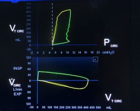 Understanding Ventilator Basics and Ventilator Waveforms | RT