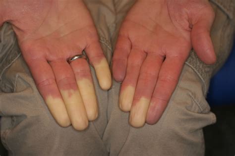 Phénomène De Raynaud Actualités Médicales Quotidienne Medical Actu Actualités Médicales