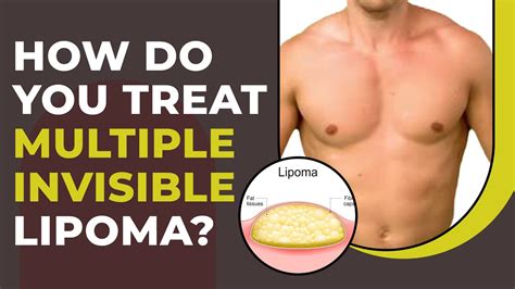 How Do You Treat Invisible Multiple Lipoma Multiple Lipoma Surgery