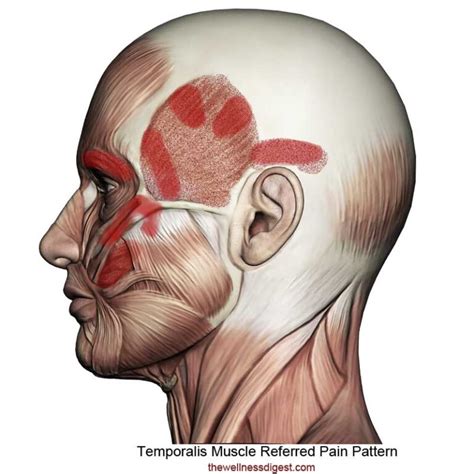 Temporalis Muscle Headaches Head Cheek Teeth Pain The Wellness