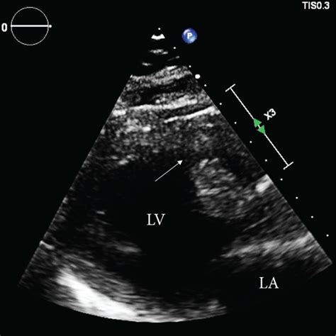 Transthoracic Echocardiogram Parasternal Long Axis View Demonstrating