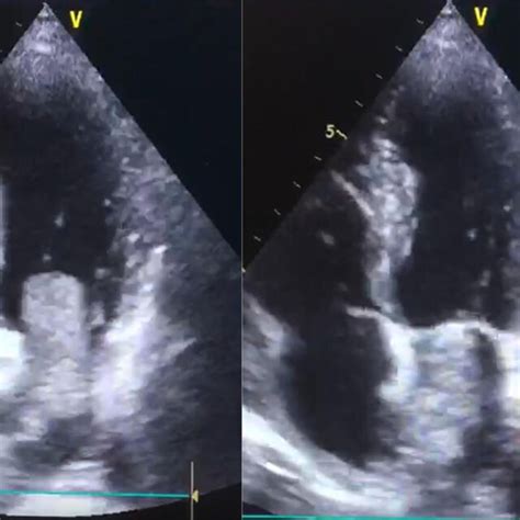 Transthoracic Echocardiography During Hospitalization Showing A Large