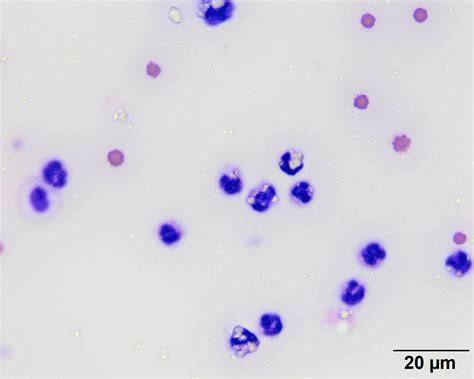 Plasmodium Falciparum Peritoneal Fluid