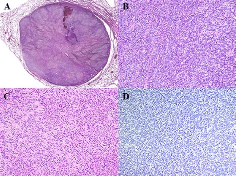 Fig Ure 1 Pathologic Examination Of The Metastatic Lg Ess The Tumor