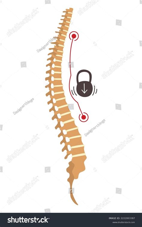 Spinal Deformity Symbol Of Spine Curvatures Or Royalty Free Stock