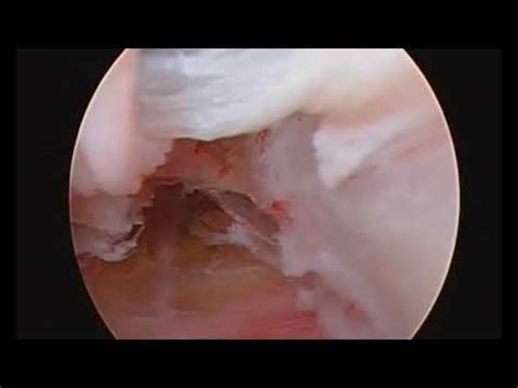 Biceps Tenoscopy In Arthroscopic Treatment Of Primary Synovial