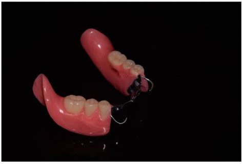 Prosthesis Free Full Text Removable Partial Denture Frameworks In The Age Of Digital