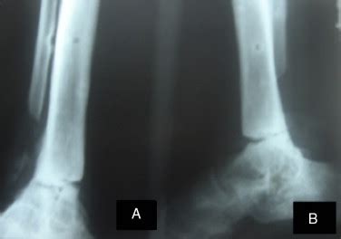 Radiografias Em Anteroposterior A E Perfil B Do Tornozelo Que