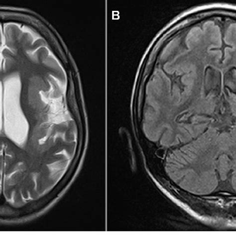 T2 Weighted Axial Magnetic Resonance Image A And Fluid Attenuated