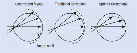 Add Multifocals To Your Myopia Toolbox