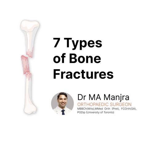 7 Types Of Bone Fractures Orthopaedic Surgeon Durban