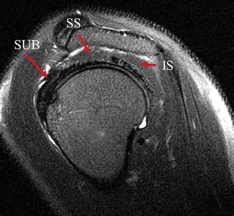 The Evolving Roles Of Mri And Ultrasound In First Line Imaging Of Rotator Cuff Injuries Ajr