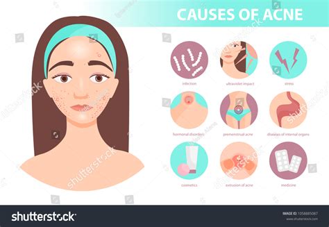 Acne Types Causes And Treatment Infographics Vector Image Hot Sex Picture