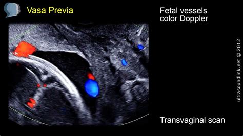 Vasa Previa Ultrasound Diagnosis Youtube