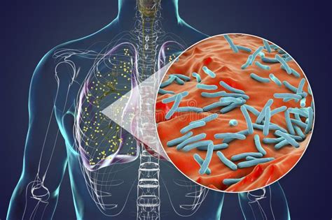 Pulmones Humanos Afectados Por La Tuberculosis Miliar Con Una Vista De