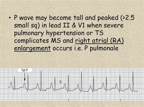 Mitral stenosis | PPT