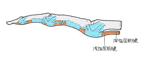 手指屈筋腱損傷（しゅし くっきんけん そんしょう） 福岡の弁護士による後遺障害・等級認定サポート