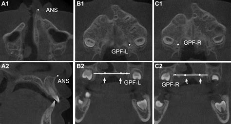 A New Method Of Volumetric Assessment Of Alveolar Bone Grafting For