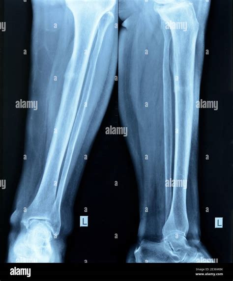 Fracture Tibia Small Tibial Fracture Stock Photo Alamy