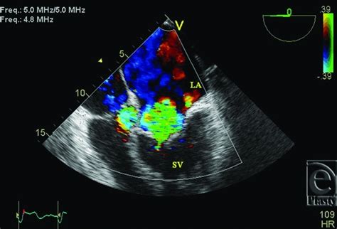 Transesophageal Echocardiogram Color Doppler Showing Severe Systemic