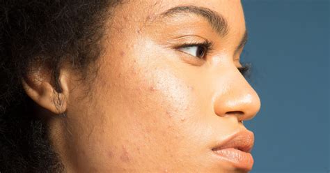 Best Acne Makeup Tutorial Youtube