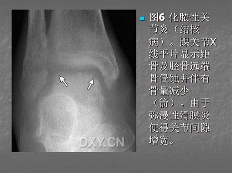 关节炎的x线评价，太全面了！ 好医术早读文章 好医术 赋能医生守护生命