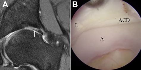 Accuracy Of Magnetic Resonance Imaging In The Diagnosis Of Acetabular