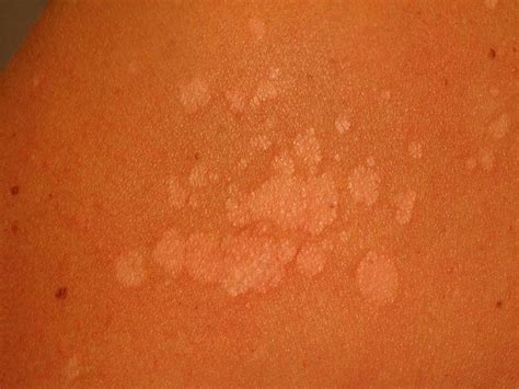 Tinea Versicolor Symptoms Causes Diagnosis And Treatment