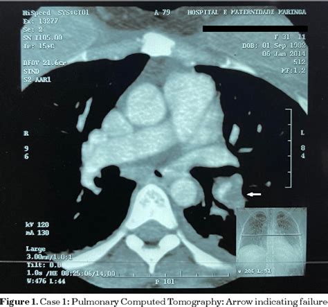 Figure From Pulmonary Thromboembolism Due To Superficial Venous