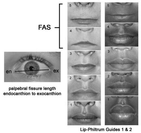 Figure 1 Palpebral Fissure And Lip Philtrum Guide Addressing Fetal