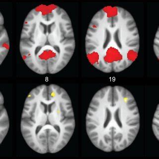 Connectivity Of Left Posterior Cingulate Seed And Between Group