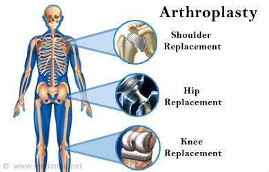 Arthroplasty - Surgical Procedure, Risks, Complications, Recovery ...