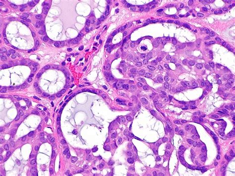 Cribriform Adenocarcinoma