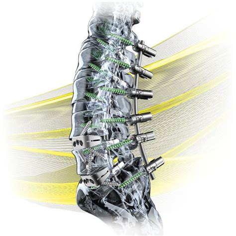 What Are Spinal Implants Siora Surgicals Private Limited