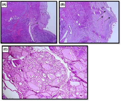 Histopathological finding. (A) Parathyroid tumoral nodule with thick ...