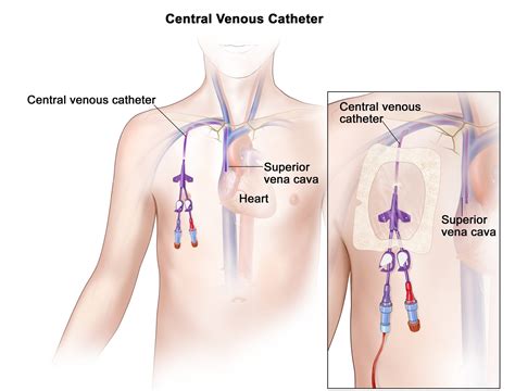 Central Venous Access Devices CVADs Dr Sravan