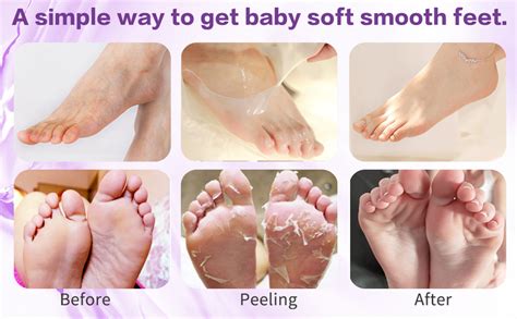 Baby Foot Peel Before And After | ubicaciondepersonas.cdmx.gob.mx