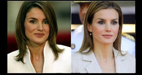 La Reina Letizia Antes Y Despu S De Sus Presuntas Cirug As