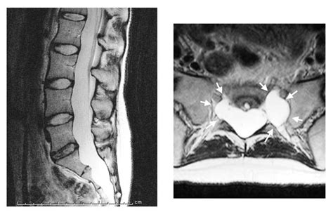 A Sagittal T Weight Spin Echo Mr Image Left Showed Bulging Of Dural