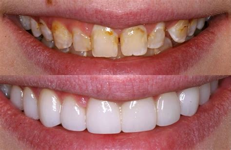 Before And After Veneers