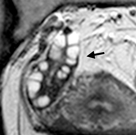 Polycystic Ovarian Syndrome Role Of Imaging In Diagnosis Radiographics