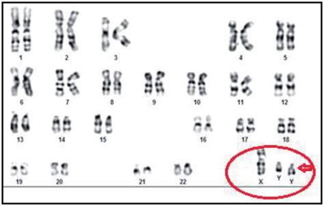 Karyotype Showing 47 XYY Indicating Jacob Syndrome Or XYY Syndrome